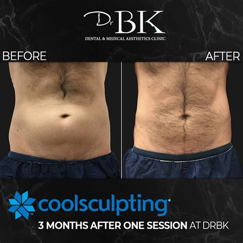coolsculpting breckenridge|CoolSculpting Fat Freezing Treatments, Side Effects & Results.